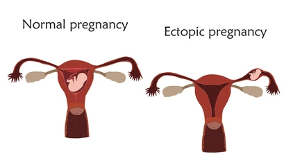 Understanding the Process of Pregnancy and the Importance of Timely Care